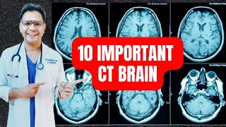 10 Important CT Brain radiology neuroradiology [upl. by Enilemme]