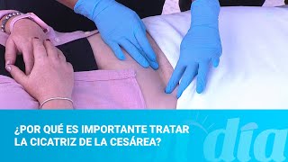 ¿Por qué es importante tratar la cicatriz de la cesárea [upl. by Ahsaercal]