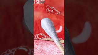 ASMR Zombie oral treatmentoral stones stomatitis tonsillitis treatment animation asmr좀비 압안결석치료 [upl. by Yesnek]