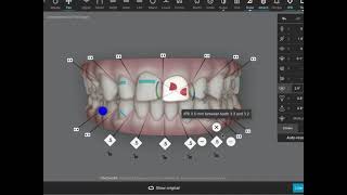 How to close upper diastema with clear aligner treatment and planning tips for Invisalign Spark [upl. by Hartill]