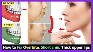 7 Steps How to Fix Overbite small chin big thick upper lip without braces naturally [upl. by Ainez]