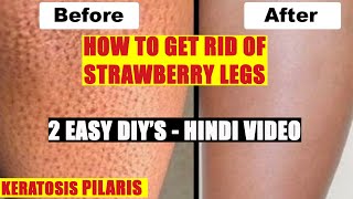 How to Get Rid of Strawberry Legs Fast  Hindi Easy DIY  Wamika Beauty [upl. by Opportuna]