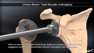 Univers Revers™ Total Shoulder Arthroplasty [upl. by Pickard281]