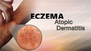 What is Eczema A Type of skin condition I Atopic Dermatitis I Allergic eczema I Neurodermatitis [upl. by Ahsrop]