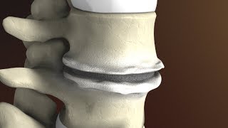 Degenerative Disc Disease Spondylosis explained by Spine Surgeon Dr Jessica Shellock Plano TX [upl. by Aerdnuahs271]