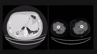 Cavitating lung lesions are a classic exam case [upl. by Fisk693]