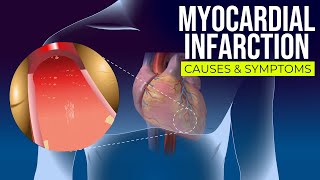 MYOCARDIAL INFARCTION  CAUSES  SYMPTOMS  RISK FACTORS  Silent Infarction [upl. by Shumway]