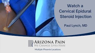 Head or Neck Pain A Cervical Epidural Steroid Injection May Help Watch it Live [upl. by Koloski]