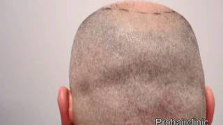 Donor area shaved after Mega FUE session hair transplant [upl. by Nautna]