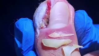 Removing Severely Infected Ingrown Toenails Patient Feels Relief After the Surgery [upl. by Anaig240]