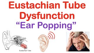 Eustachian Tube Dysfunction “Popping Sound in Ears”  Causes Symptoms Diagnosis Treatment [upl. by Niamrej]