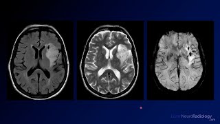 Neuroradiology Board Review  Brain Tumors  Case 17 [upl. by Ymled]