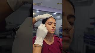 PICO Laser technology picolaser laser skincare pigmentation beauty pico fillers botox yt [upl. by Airan]