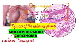 Mucoepidermoid carcinoma Histopathology  Clinical features  DETAILED  BDS NEET MDS [upl. by Angy]