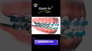 Underbite braces transformation bracesorthodontist dentist shortsfeed [upl. by Amesari100]