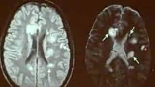 MRI of Multiple Sclerosis [upl. by Trauts]