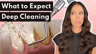 What To Expect From a DEEP Cleaning at the Dentist [upl. by Berta]