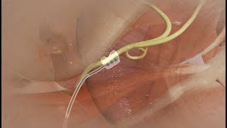 Hypoglossal Nerve Stimulator Device Implantation [upl. by Hiamerej32]