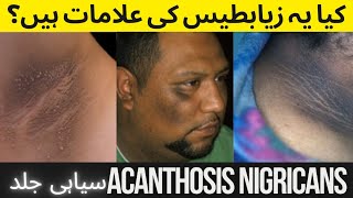 Acanthosis Nigricans Causes  Symptoms Treatment [upl. by Henebry133]