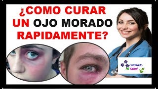 💡 COMO CURAR UN OJO MORADO  3 pasos para tratar y eliminar Moretones o Hematoma facial 2021 ✅ [upl. by Daffie]