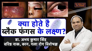 Coronavirus MucormycosisBlack Fungus Symptoms in Hindi Dr Abhay Kumar Singh SrENT Consultant [upl. by Enneiviv]