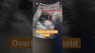 Dermoid cyst ovaries radiology ultrasound sonography [upl. by Ajuna]