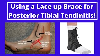 Using a Lace up Brace for Posterior Tibial Tendinitis [upl. by Harned364]