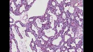 Histopathology Lung Interstitial pneumonia [upl. by Grindle]