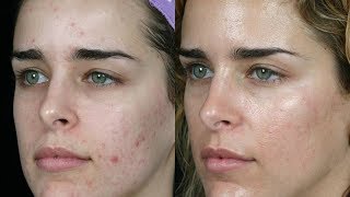 ELIMINA EL ACNE CON AZUFRE – RESULTADOS INCREIBLES [upl. by Warden]