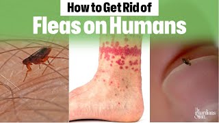 Ultimate Guide How to Get Rid of Fleas on Humans Fast [upl. by Mariande172]