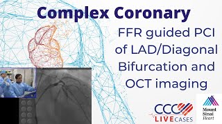 FFR guided PCI of LADDiagonal Bifurcation and OCT imaging  CCC Live April 2016 [upl. by Sakovich]