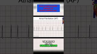 Atrial Fibrillation Causes Symptoms and Treatments  Explained by a Medical Professional [upl. by Liberati]