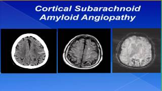 Cortical Subarachnoid Hemorrhage by Sebastian Koch MD [upl. by Marcelline]