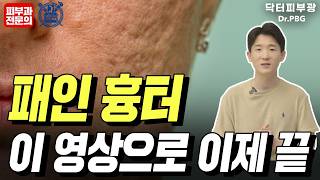 여드름 패인 흉터도 없앨 수 있을까 여드름 흉터 전문가가 알려드리는 치료 방법  피부과전문의 닥터피부광 의학박사 피부과전문의 전지훈 [upl. by Island497]