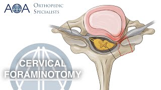 AOA Orthopedic Specialists  Cervical Foraminotomy [upl. by Landri]