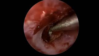 Ear drum repair tympanoplasty with lateral graft [upl. by Drarreg]