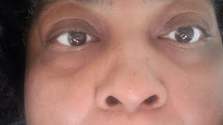 Update On My Recovery surgeryrecovery nose recovery [upl. by Grindlay910]