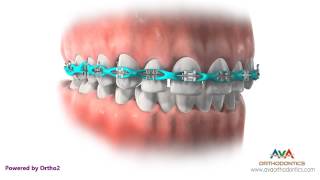 Space Closure by Power Chain  Orthodontic Treatment [upl. by Howlond]