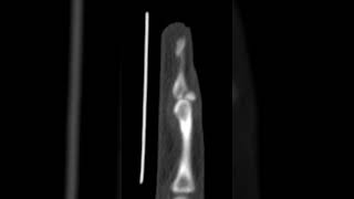 Bony mallet finger [upl. by Llieno]