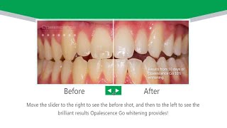 Opalescence Go  Take Home Teeth Whitening [upl. by Ursala]