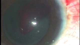 Surgical management of Hyphema  Dr Pradip Mohanta MS Ophth [upl. by Olen]