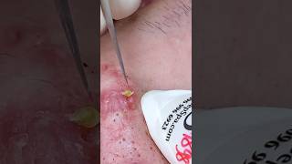 P001  SacDepSpa acne pimple sacdepspa blackheads [upl. by Neehs]