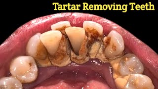 Best tartar removal Ive ever seen  tartar removing  tartar [upl. by Siegler570]