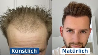 Haartransplantation künstliche vs natürliche Haarlinie Woran erkennt man es [upl. by Suolekcin167]