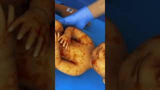 Cesarean operation  Csection birth  C section stitches  C section kya hai  Dr Neeraj Pahlajani [upl. by Aloke]