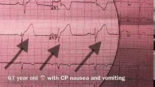 Inferior myocardial infarction [upl. by Aikaj462]