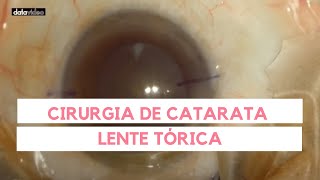 Vídeo de Cirurgia de Catarata com Implantação de Lente Intraocular Tórica  Dr Olho [upl. by Bashemeth]