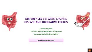 DIFFERENCES BETWEEN CROHNS DISEASE ULCERATIVE COLITIS AND INVESTIGATIONS IN IBD  By DrVShanthi [upl. by Herminia780]