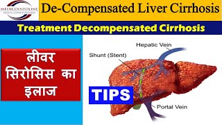 Decompensated liver cirrhosis  Decompensated liver disease [upl. by Maclay]