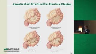 Diverticulitis To Operate or Not [upl. by Nrehtac]